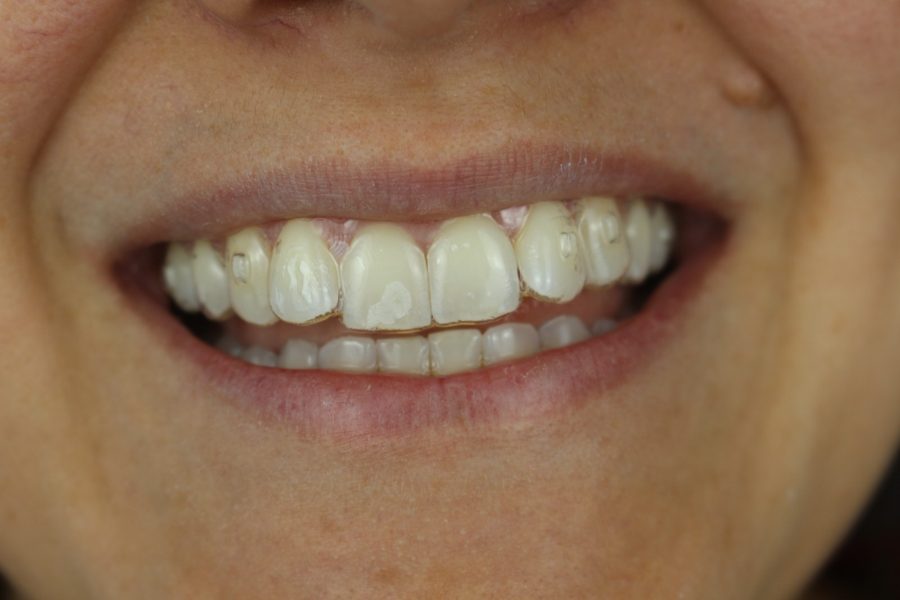 Paciente usando alinhador invisível, aparelho transparente quase imperceptível no sorriso