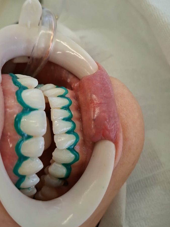 Gengiva protegida com barreira antes do clareamento dental de consultório