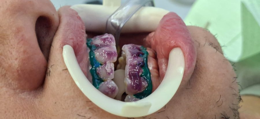 Gel clareador aplicado nos dentes durante o clareamento de consultório em Guarulhos