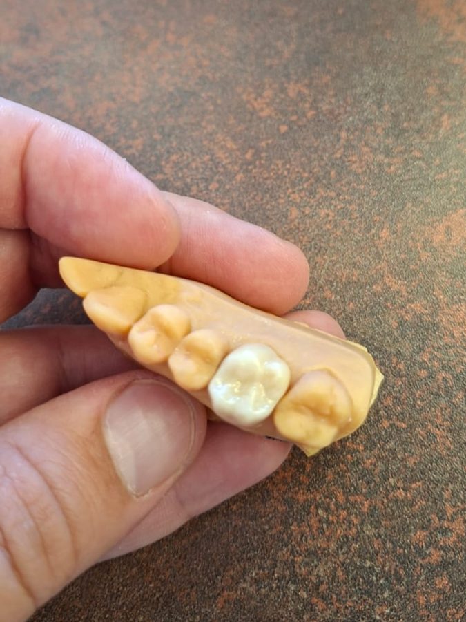 Coroa dentária posicionada no modelo antes da instalação, feita pelo Dr. Leonardo Reberte em Guarulhos