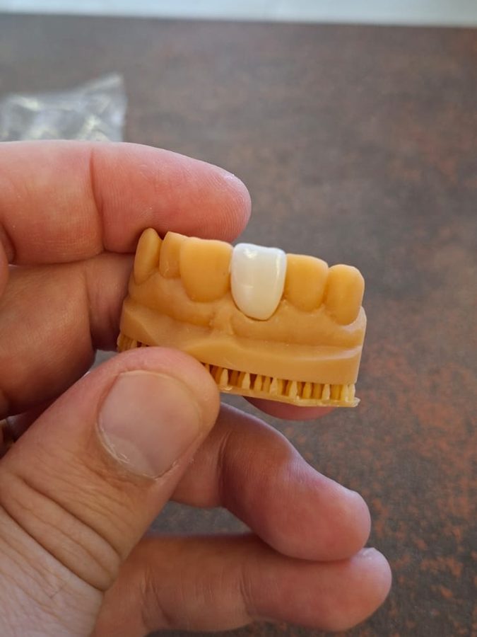 Coroa sobre implante no dente da frente, conferida no modelo antes da instalação