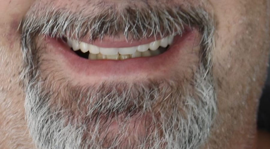 Sorriso de paciente com prótese protocolo sobre implantes feita pelo Dr. Leonardo Reberte em Guarulhos