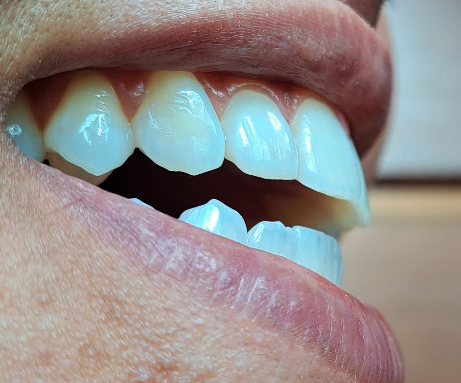 Clareamento dental de consultório, close-up dos dentes