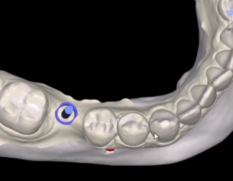 Planejamento digital em 3D marcando a posição do implante dentário