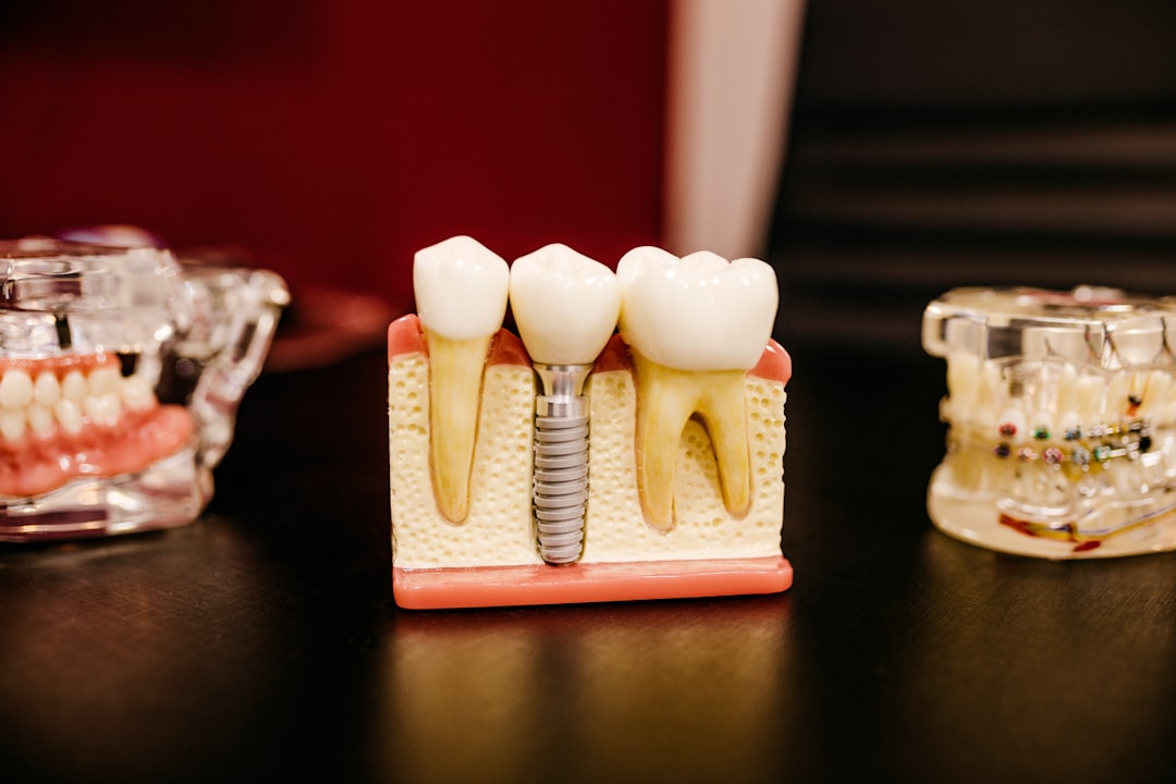 Modelo demonstrativo de implante dentário com coroa sobre osso