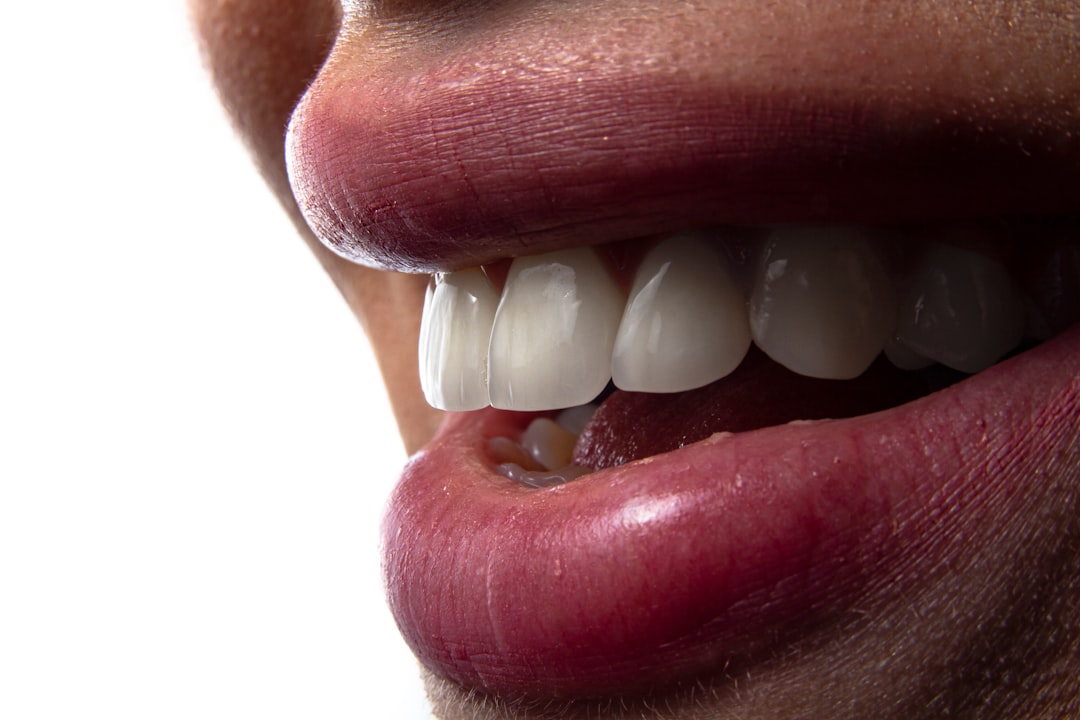 Sorriso com lentes de contato dental em porcelana